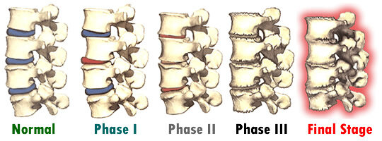 Degenerative Disc Disease