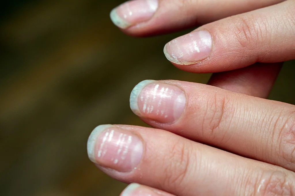 Nail Disease